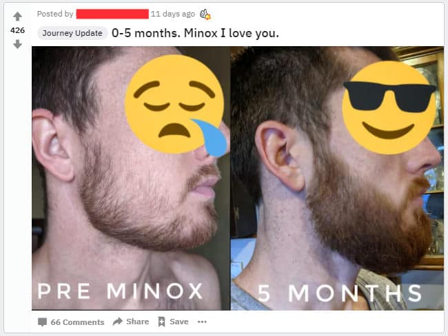 filling cheek beard results