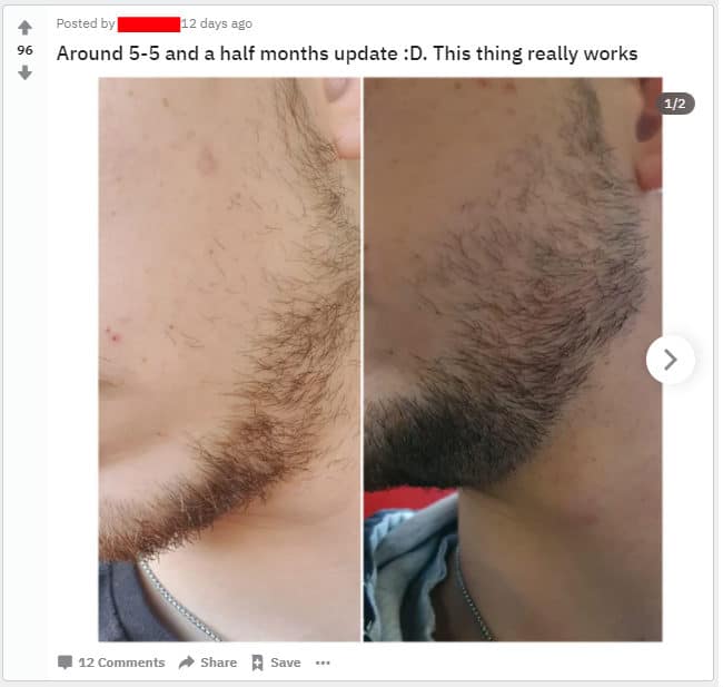 growing more cheek beard with minoxidil