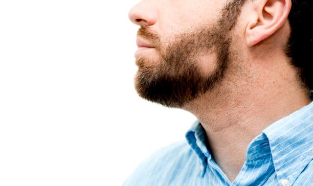 man with alopecia on his beard