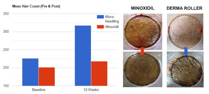 microneedling hair growth study results