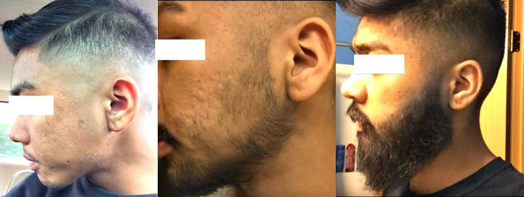 minoxidil beard growth serum before after results