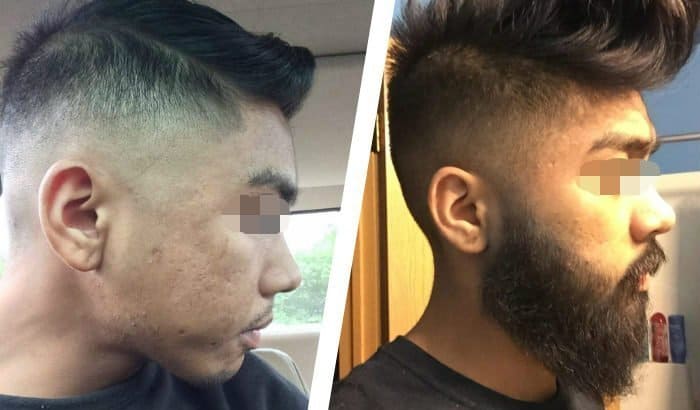 minoxidil beard before after