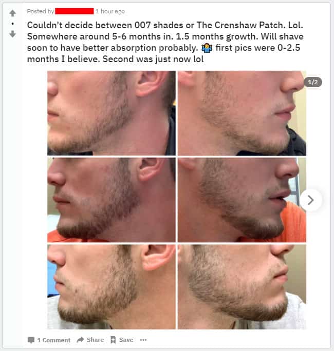 minoxidil to fix patchy cheek beard