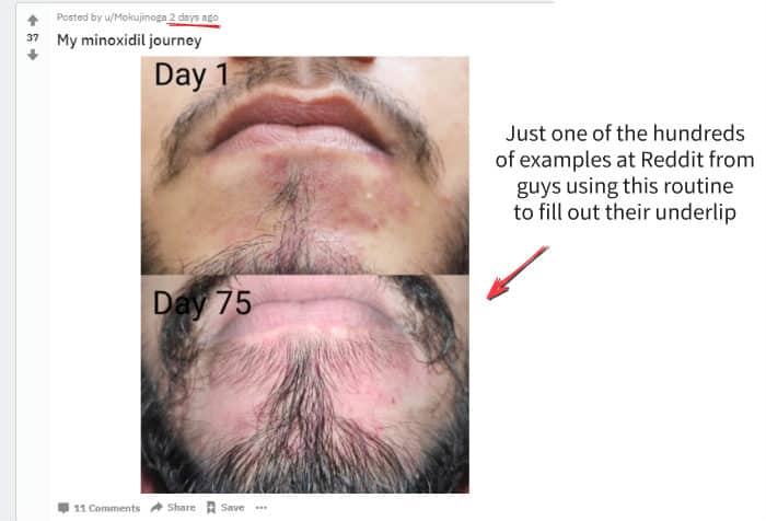 reddit beard underlip filling example