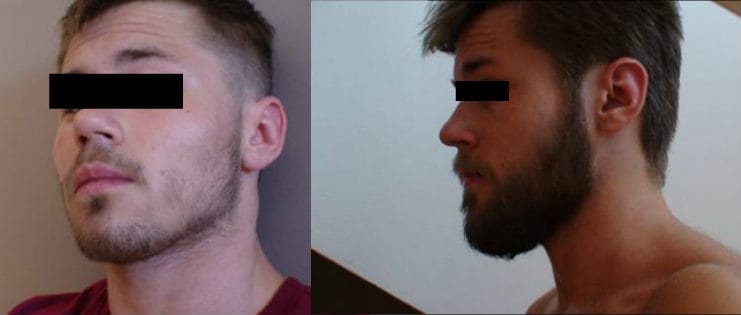 rogaine facial hair before and after results