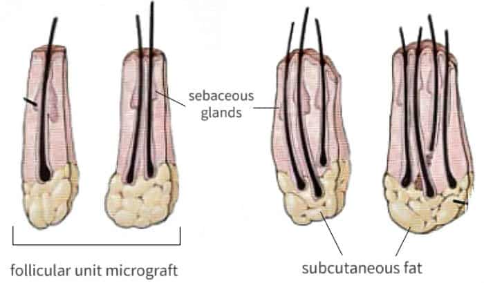 the beard transplant illustration