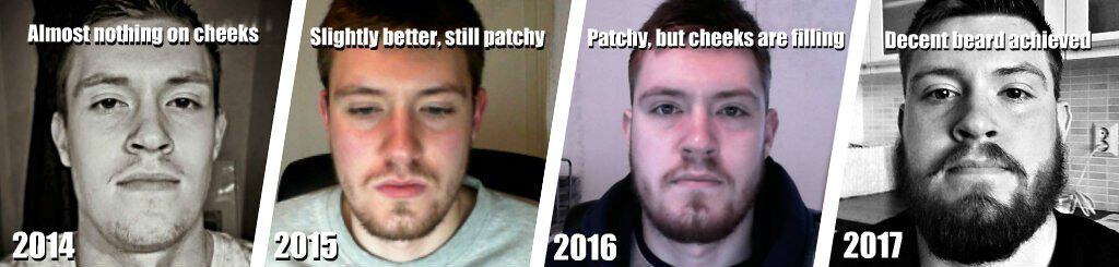 beard growth results